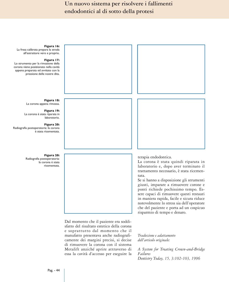 Figura 19: La corona è stata riparata in laboratorio. Figura 20: Radiografia postoperatoria: la corona è stata ricementata. 18 19 Figura 20: Radiografia postoperatoria: la corona è stata ricementata.