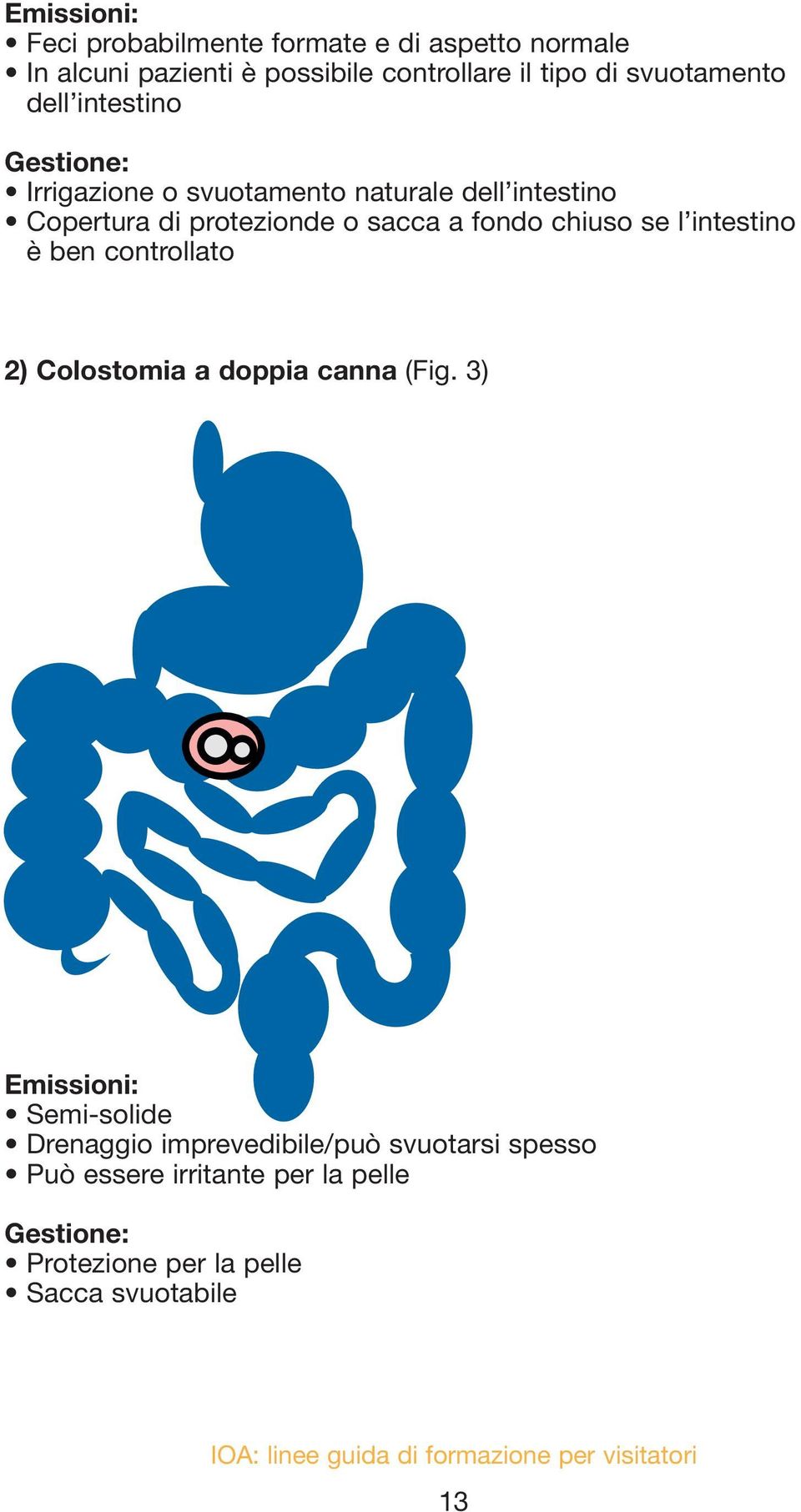 sacca a fondo chiuso se l intestino è ben controllato 2) Colostomia a doppia canna (Fig.