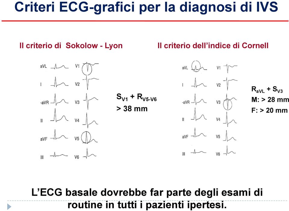 V5-V6 > 38 mm R avl + S V3 M: > 28 mm F: > 20 mm L ECG basale