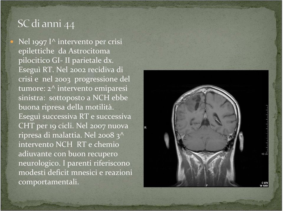 buona ripresa della motilità. Eseguì successiva RT e successiva CHT per 19 cicli. Nel 2007 nuova ripresa di malattia.