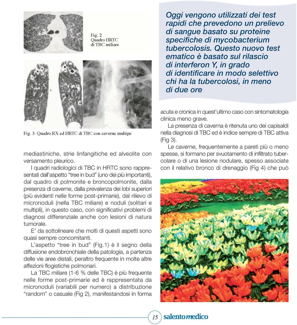 Quadro RX ed HRTC di TBC con caverne multipe mediastiniche, strie linfangitiche ed alveolite con versamento pleurico.