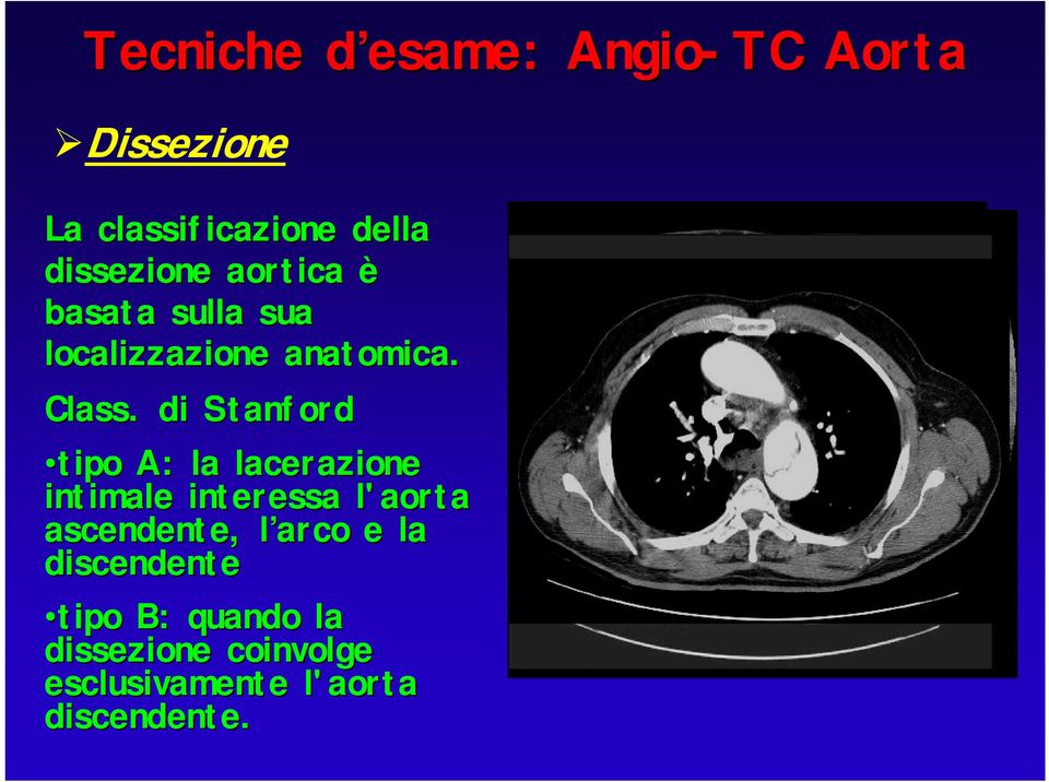 di Stanford tipo A: la lacerazione intimale interessa l'aorta