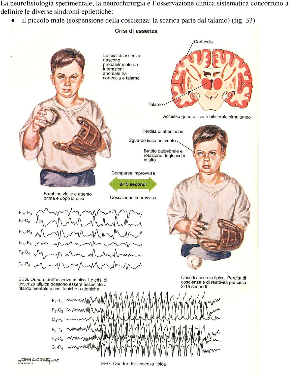 le diverse sindromi epilettiche: il piccolo male