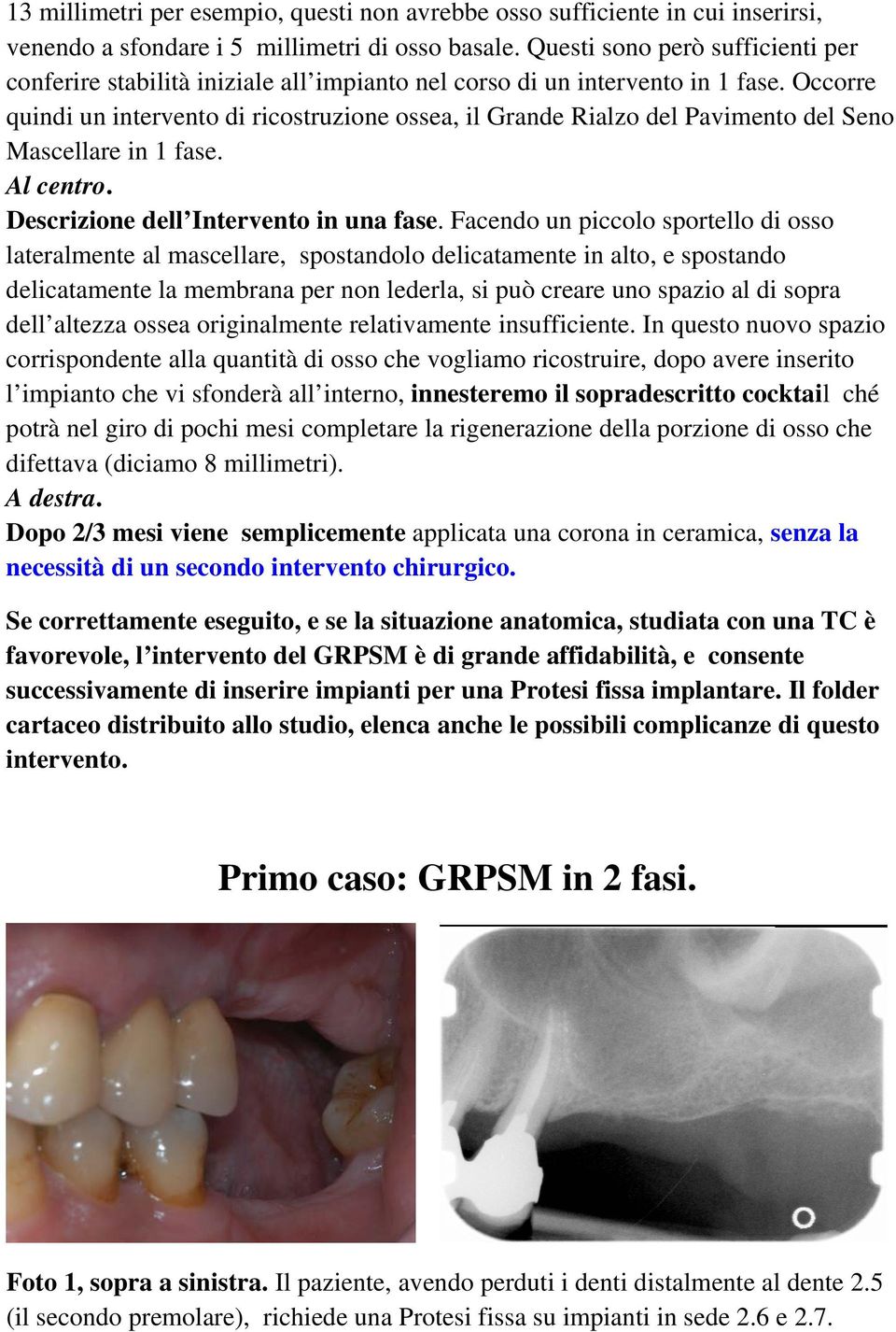 Occorre quindi un intervento di ricostruzione ossea, il Grande Rialzo del Pavimento del Seno Mascellare in 1 fase. Al centro. Descrizione dell Intervento in una fase.