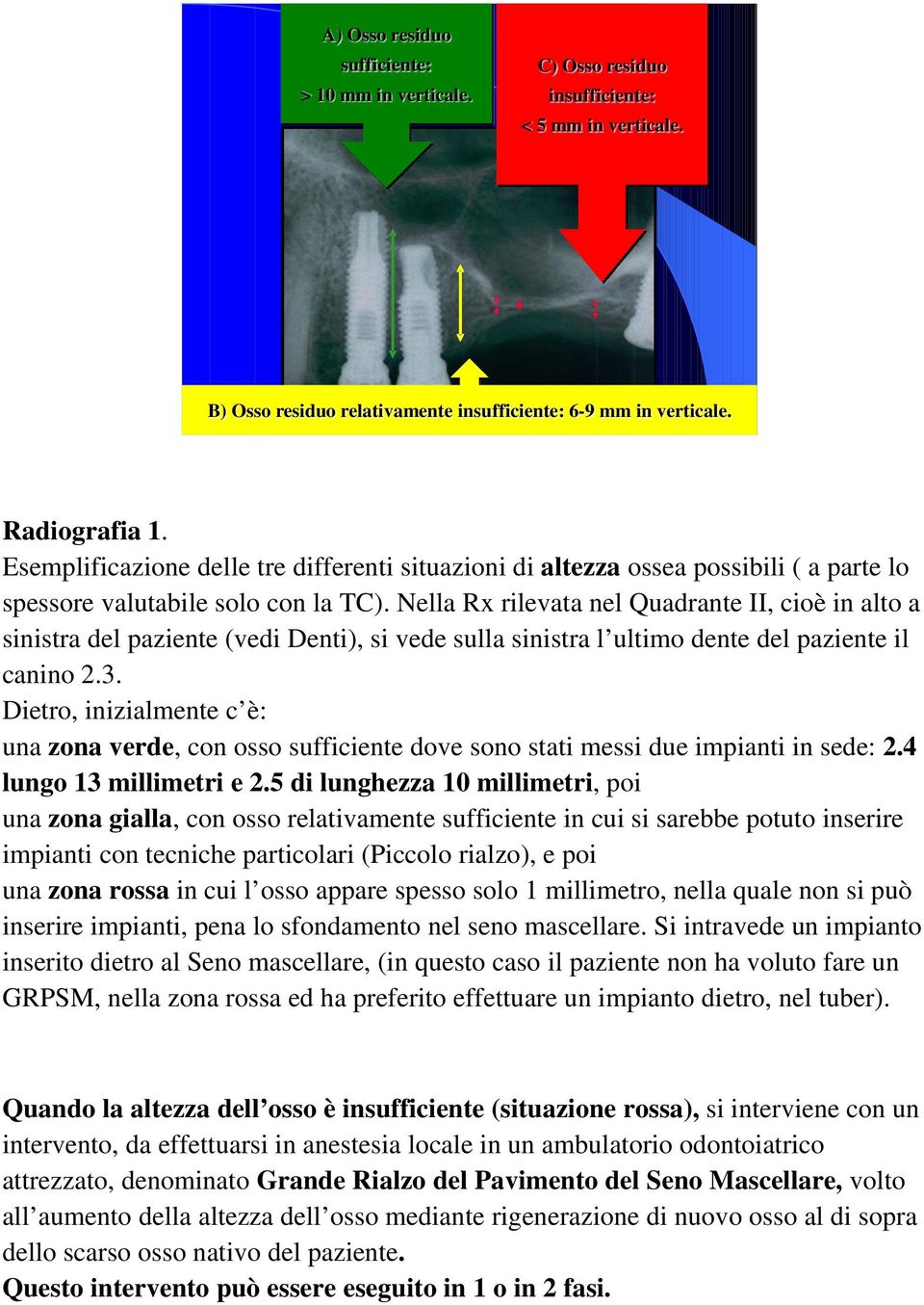 Nella Rx rilevata nel Quadrante II, cioè in alto a sinistra del paziente (vedi Denti), si vede sulla sinistra l ultimo dente del paziente il canino 2.3.