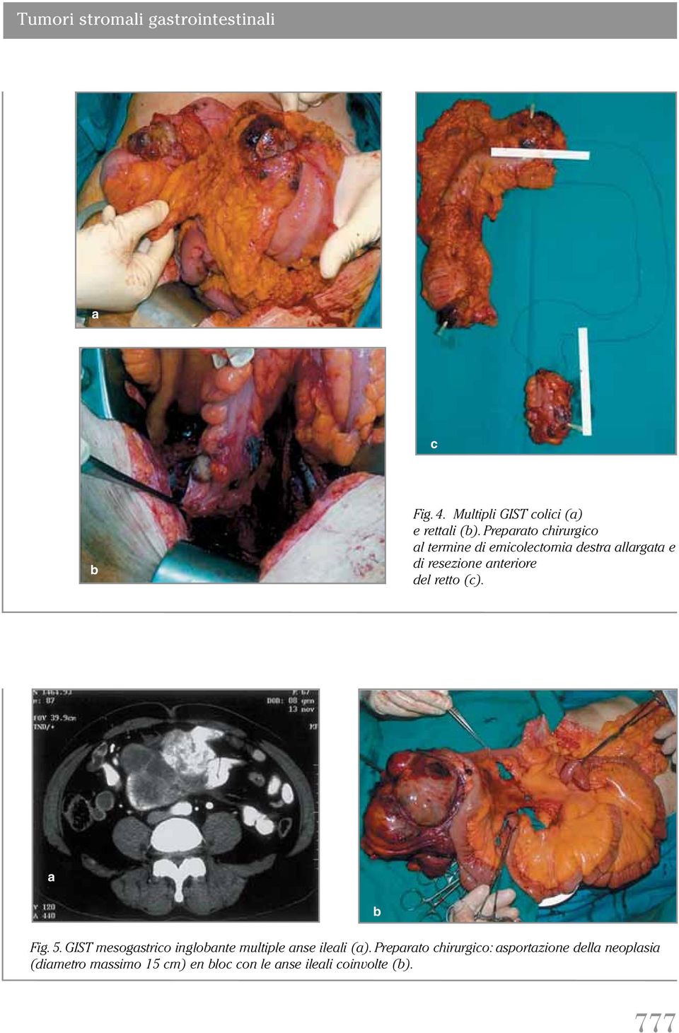 retto (c). Fig. 5. GIST mesogstrico inglonte multiple nse ileli ().