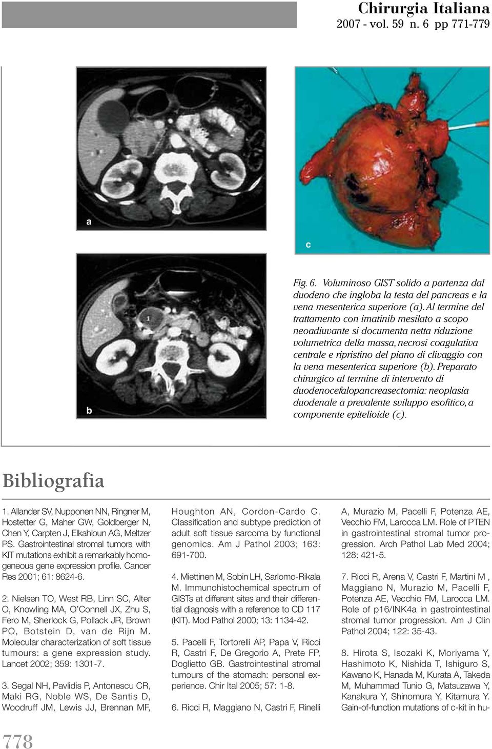 (). Preprto chirurgico l termine di intervento di duodenoceflopncresectomi: neoplsi duodenle prevlente sviluppo esofitico, componente epitelioide (c). Biliogrfi 1.