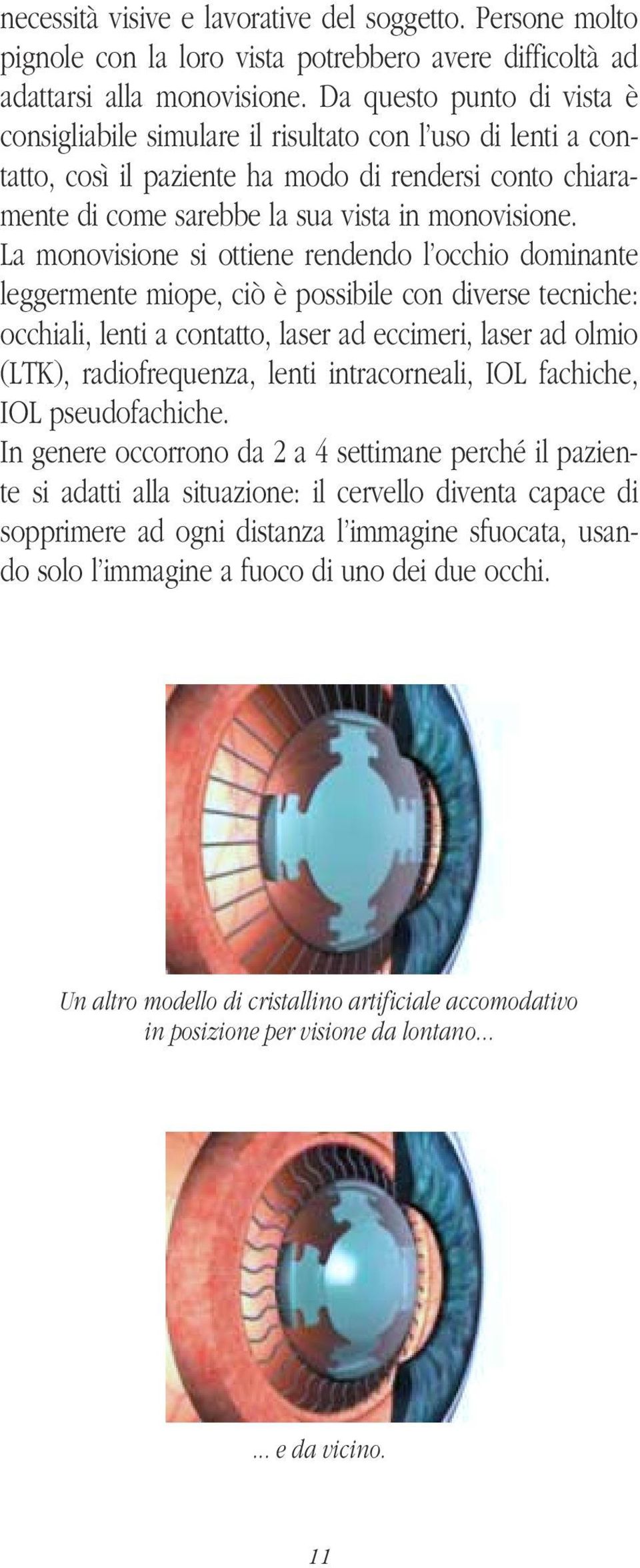 La monovisione si ottiene rendendo l occhio dominante leggermente miope, ciò è possibile con diverse tecniche: occhiali, lenti a contatto, laser ad eccimeri, laser ad olmio (LTK), radiofrequenza,