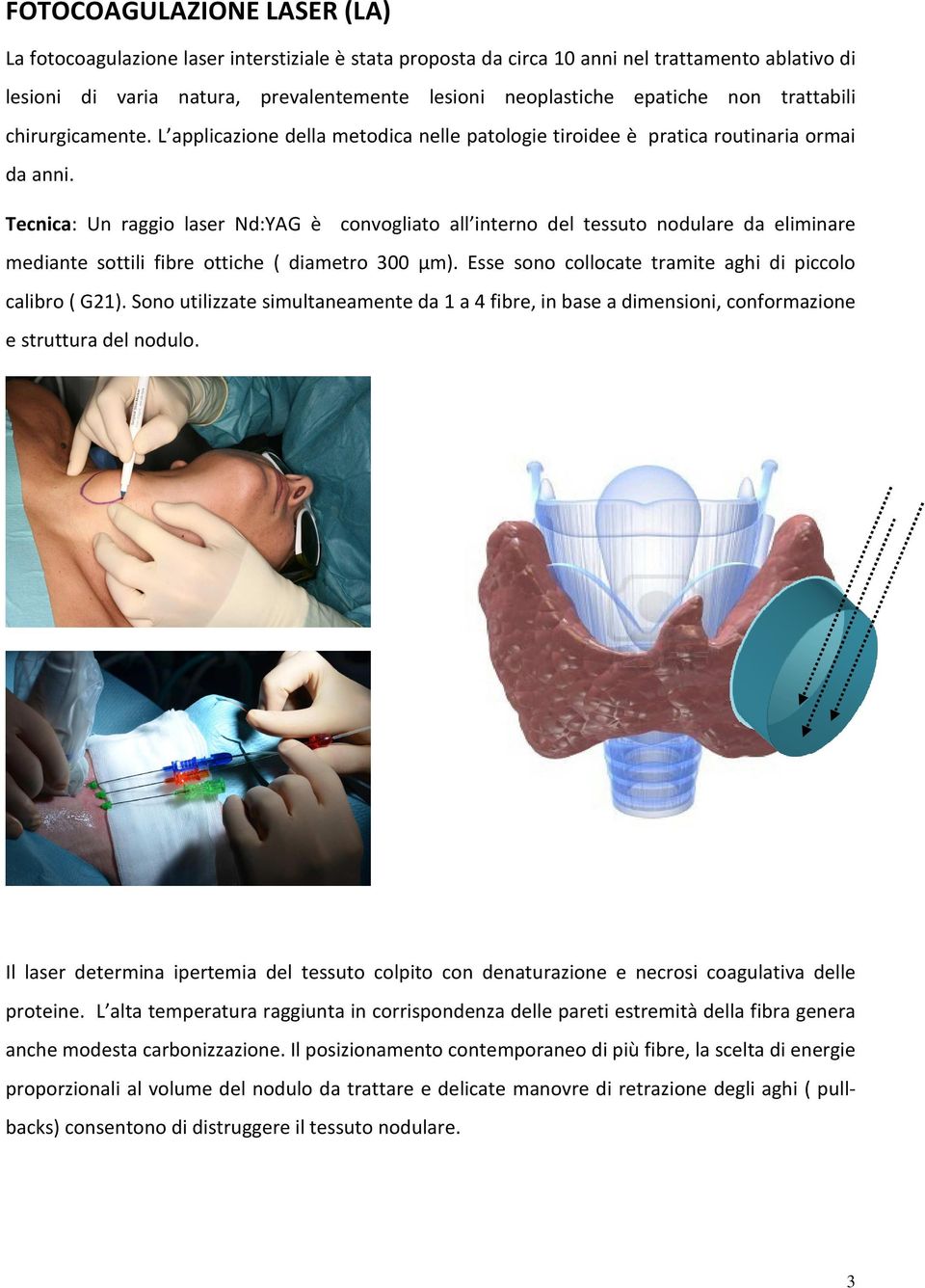 Tecnica: Un raggio laser Nd:YAG è convogliato all interno del tessuto nodulare da eliminare mediante sottili fibre ottiche ( diametro 300 µm).