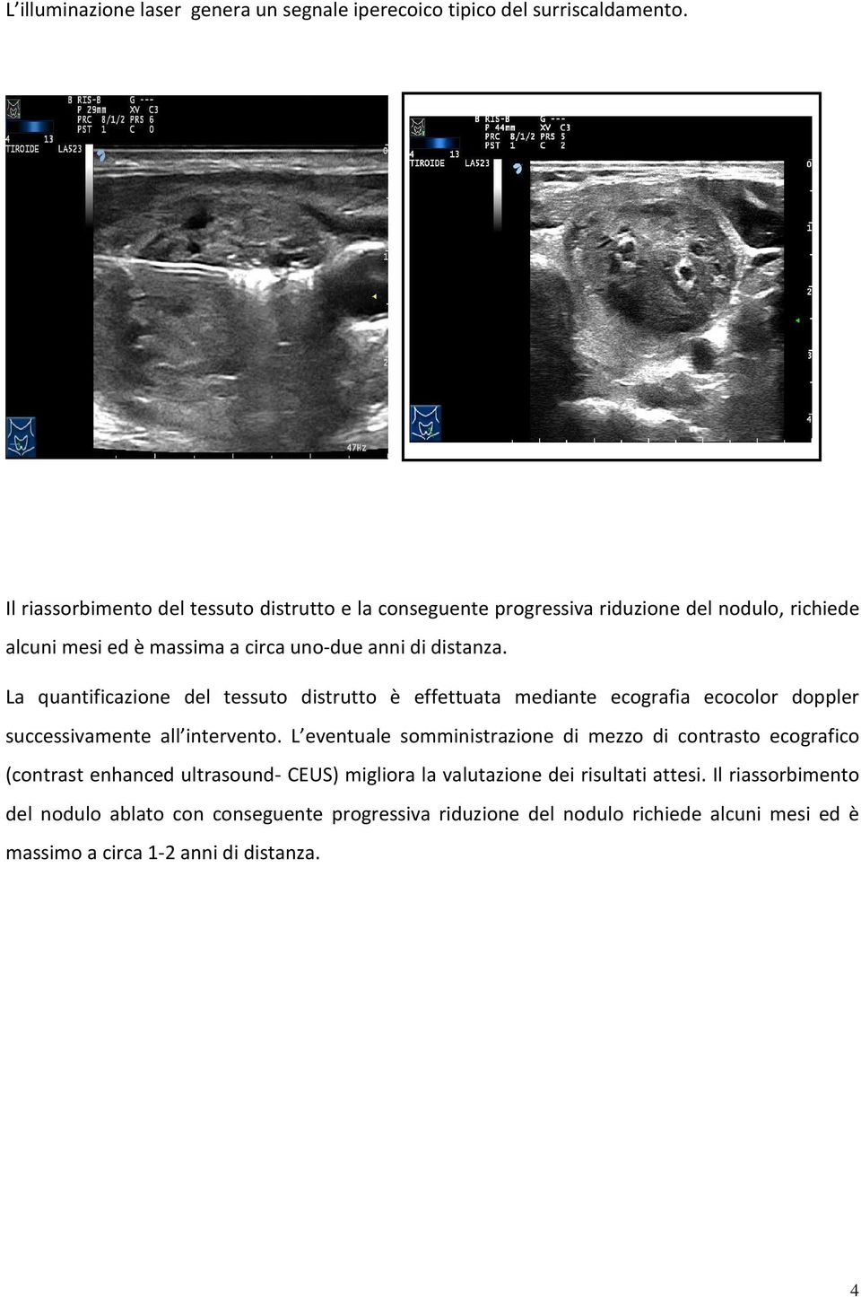 La quantificazione del tessuto distrutto è effettuata mediante ecografia ecocolor doppler successivamente all intervento.