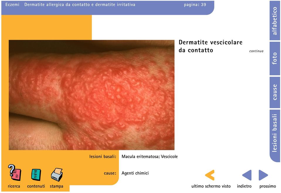 Dermatite vescicolare da contatto