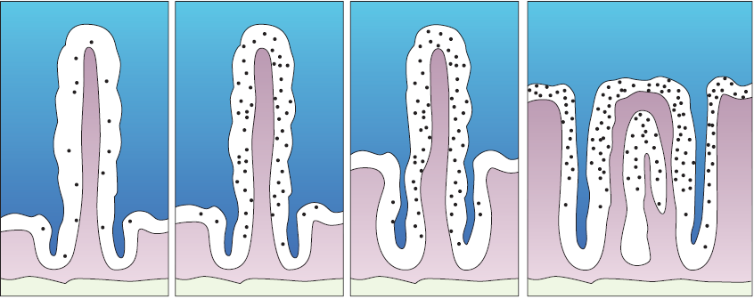 Come si fa la diagnosi: la biopsia La biopsia duodenale rimane il gold standard: non e corretto iniziare la dieta senza glutine prima della biopsia Le alterazioni