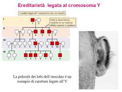 Esempi di caratteri/patologie a trasmissione Y-linked Pelosità dei lobi