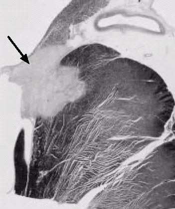 Aspetti anatomo-patologici Le modificazioni della zona di confine tra lesione e tessuto circostante sono determinanti per l eventuale recidiva aritmica successiva alla procedura.