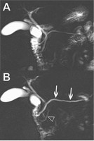 dotto dorsale dotto dorsale basale PANCREAS DIVISUM basale dopo secretina Notare come in entrambe i casi venga migliorata la rappresentazione dei