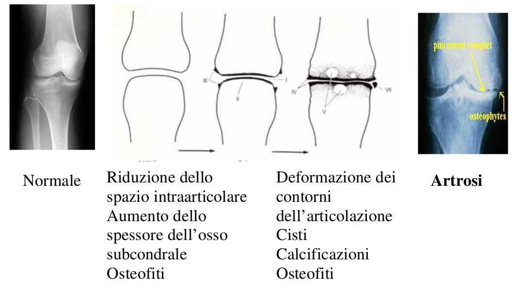 genetica, il sesso, l età, l eccesso ponderale, il male allineamento, il deficit di