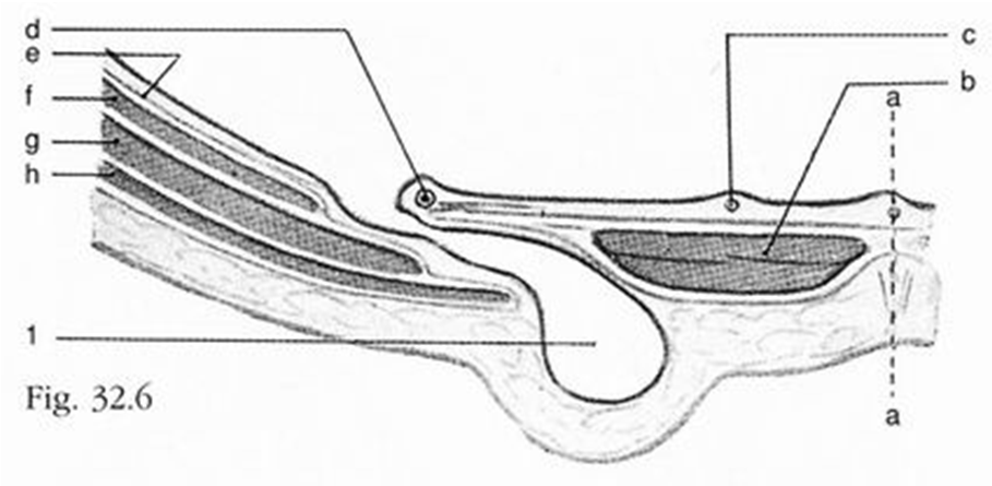 Vasi epigastrici inferiori Arteria ombelicale obliterata Uraco Ernia inguinale obliqua esterna ERNIE INGUINALI: ANATOMIA CHIRURGICA