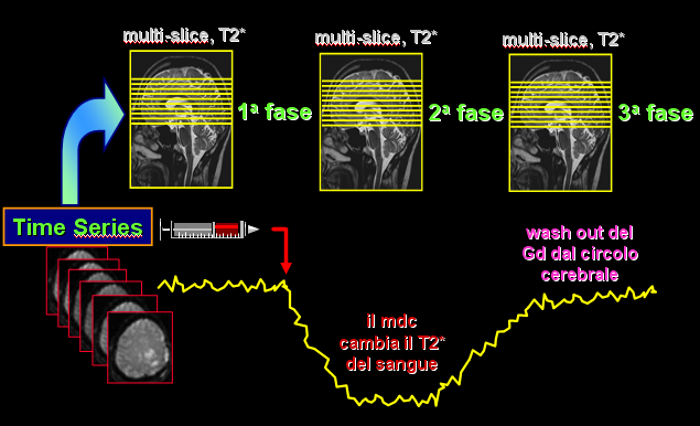 RM di Perfusione : Perfusion Weightetd Imaging (PWI) Il flusso ematico cerebrale a livello capillare può essere quantificato valutando la