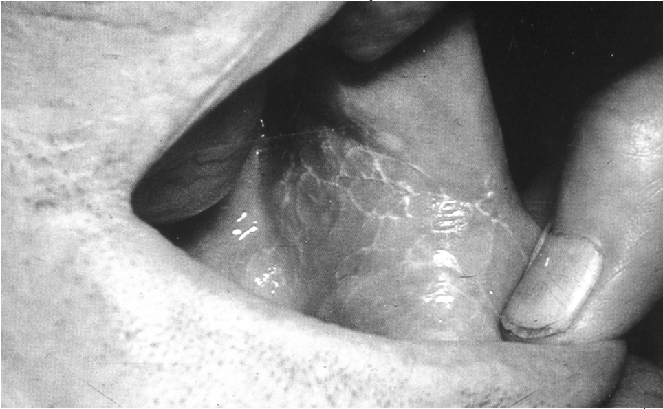 QUADRO CLINICO LESIONI MUCOSE (2/3 dei casi) Strie o reticolo biancastro ( a foglia di felce ) alle mucose geniene.