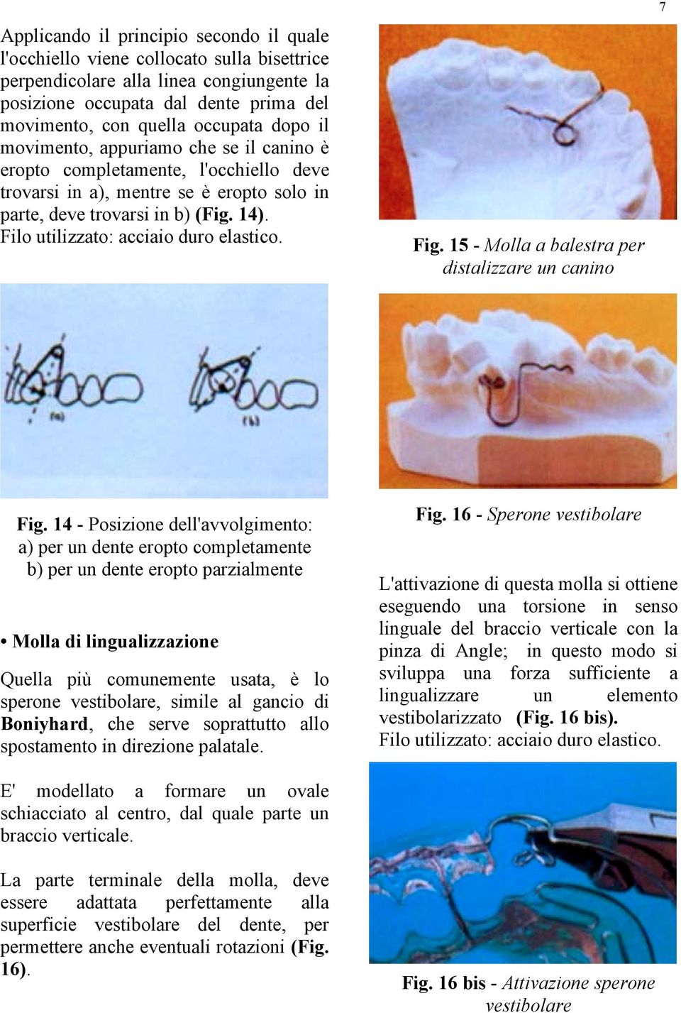 Filo utilizzato: acciaio duro elastico. Fig. 15 - Molla a balestra per distalizzare un canino 7 Fig.