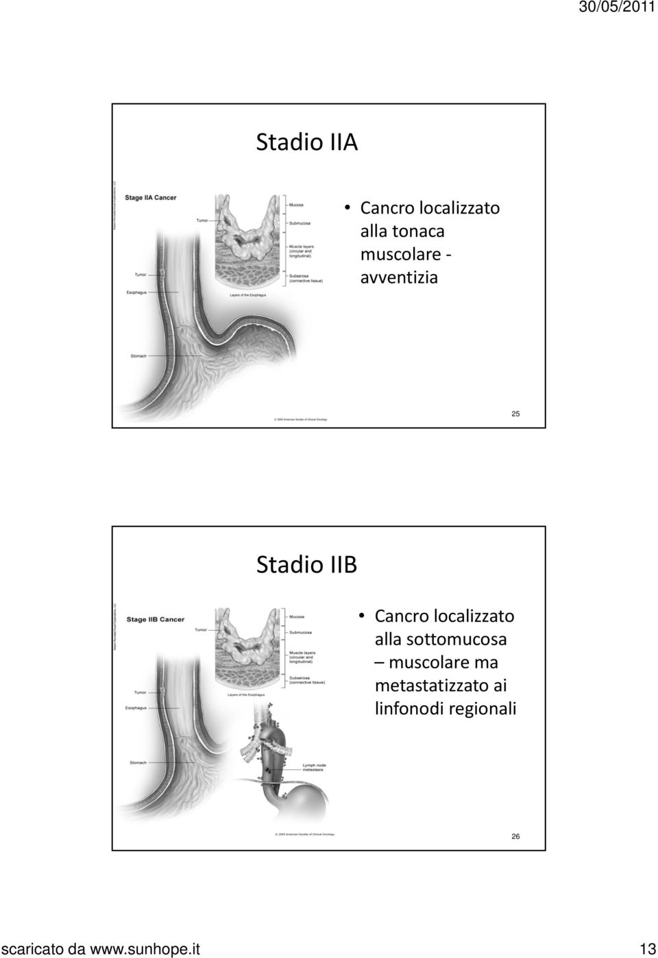 localizzato alla sottomucosa muscolare ma