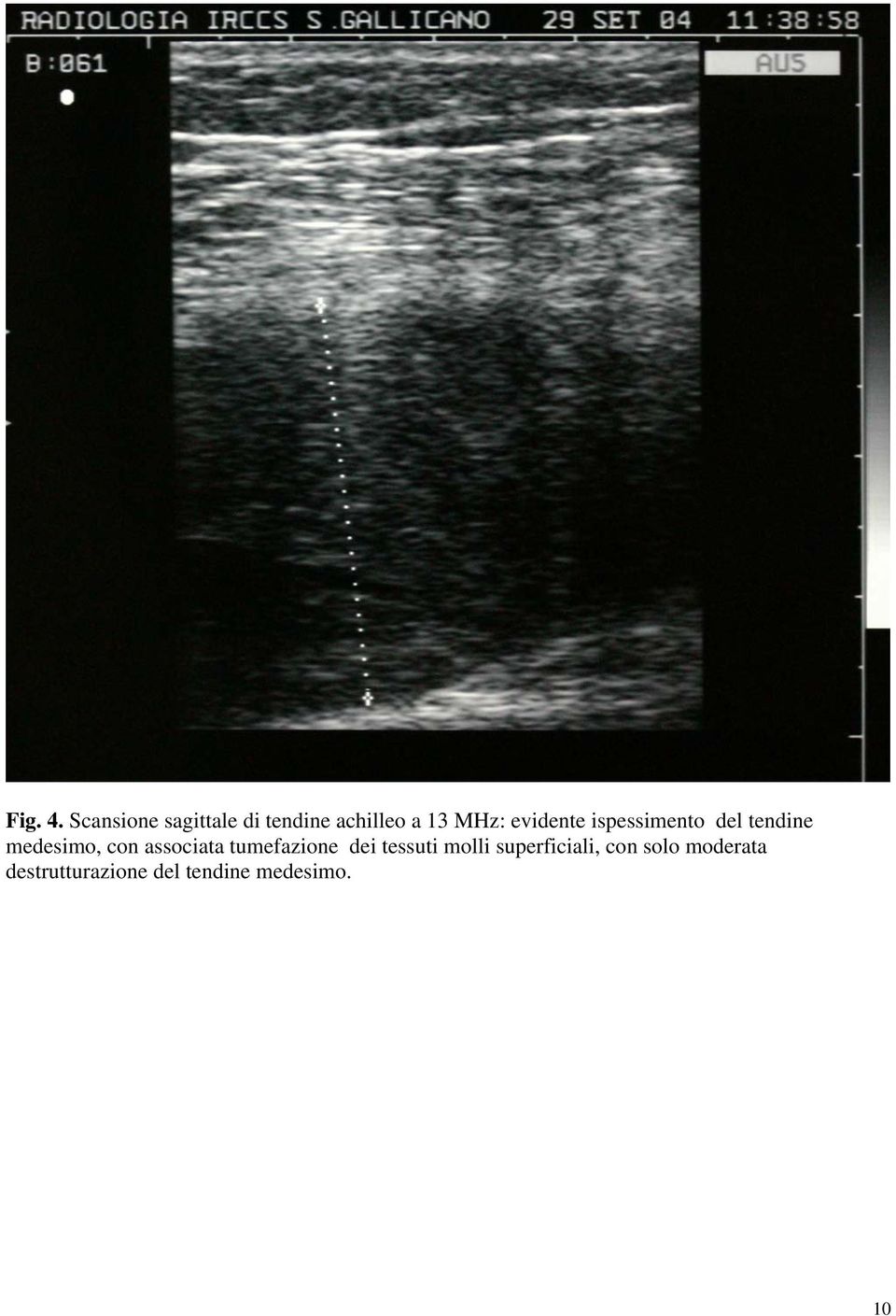 evidente ispessimento del tendine medesimo, con