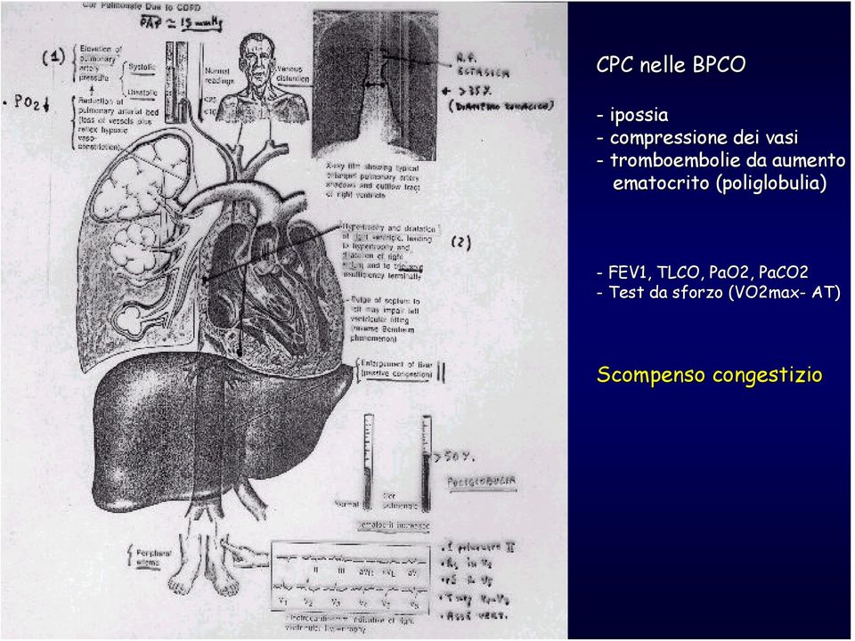 (poliglobulia( poliglobulia) - FEV1, TLCO, PaO2,