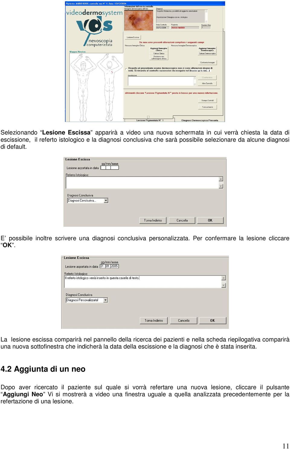 La lesione escissa comparirà nel pannello della ricerca dei pazienti e nella scheda riepilogativa comparirà una nuova sottofinestra che indicherà la data della escissione e la diagnosi che è stata