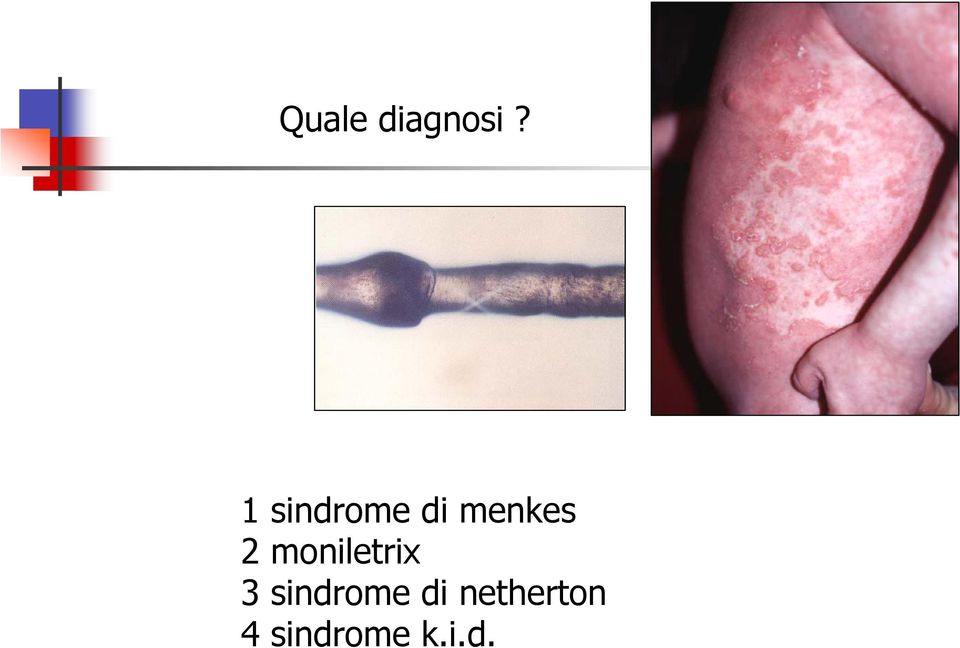 moniletrix 3 sindrome