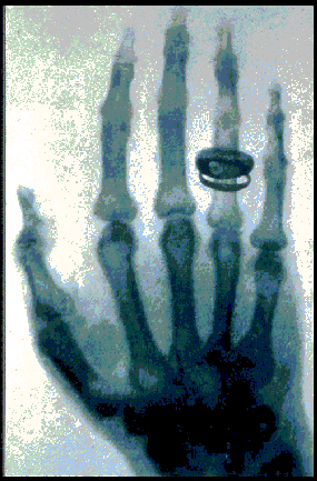 Diagnostica per immagini: Radiologia Rivelazione di raggi X emessi
