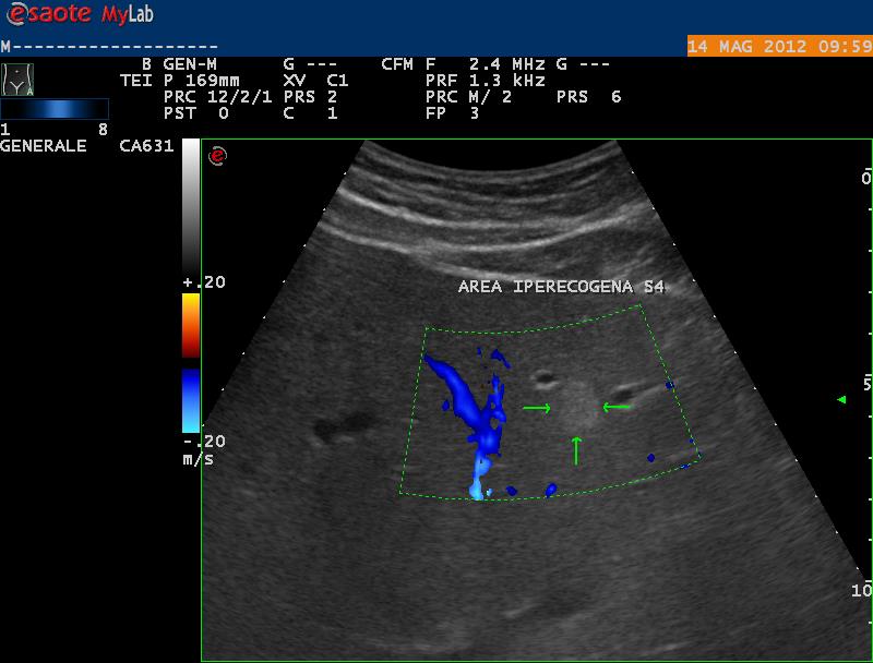 Angioma epatico Lesione focale da alutare in relazione