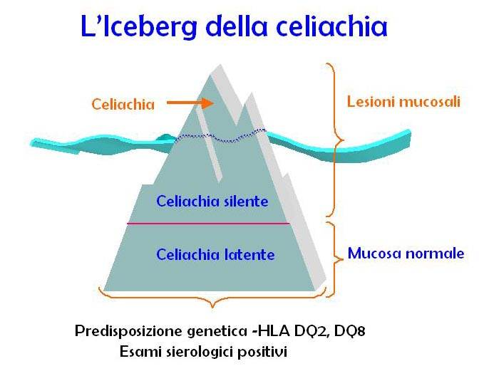 HLA e celiachia Celiachia silente: Asintomatica con atrofia