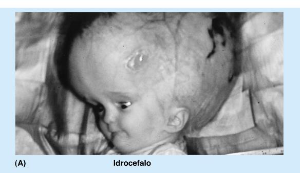 Neonato