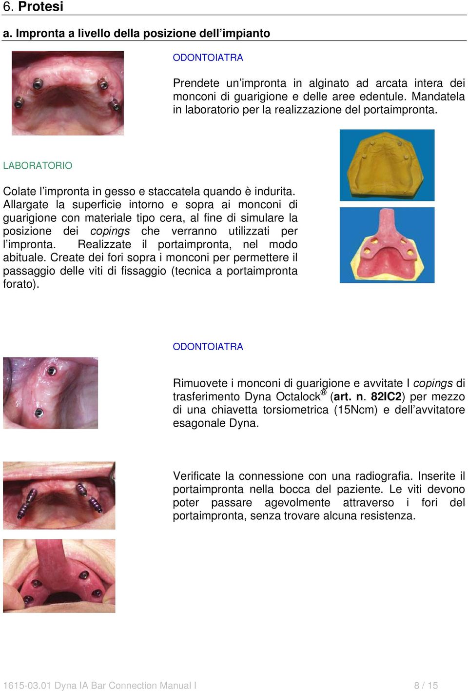 Allargate la superficie intorno e sopra ai monconi di guarigione con materiale tipo cera, al fine di simulare la posizione dei copings che verranno utilizzati per l impronta.