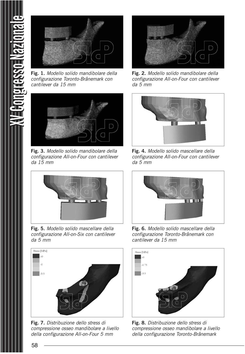 mm Fig. 5. Modello solido mascellare della configurazione All-on-Six con cantilever da 5 mm Fig. 6. Modello solido mascellare della configurazione Toronto-Brånemark con cantilever da 15 mm Fig. 7.