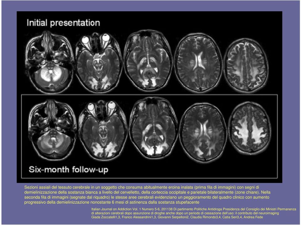 Nella seconda fila di immagini (segnate dal riquadro) le stesse aree cerebrali evidenziano un peggioramento del quadro clinico con aumento progressivo della demielinizzazione nonostante 6 mesi di