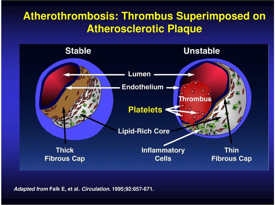 Atherosclerotic Plaque Adapted