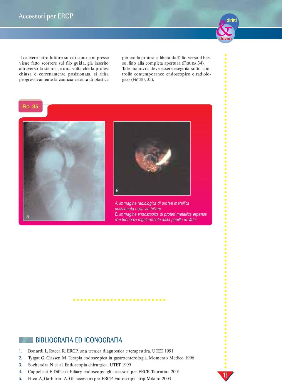 Tale manovra deve essere eseguita sotto controllo contemporaneo endoscopico e radiologico (FIGURA 35). FIG. 35 B A A. Immagine radiologica di protesi metallica posizionata nella via biliare B.