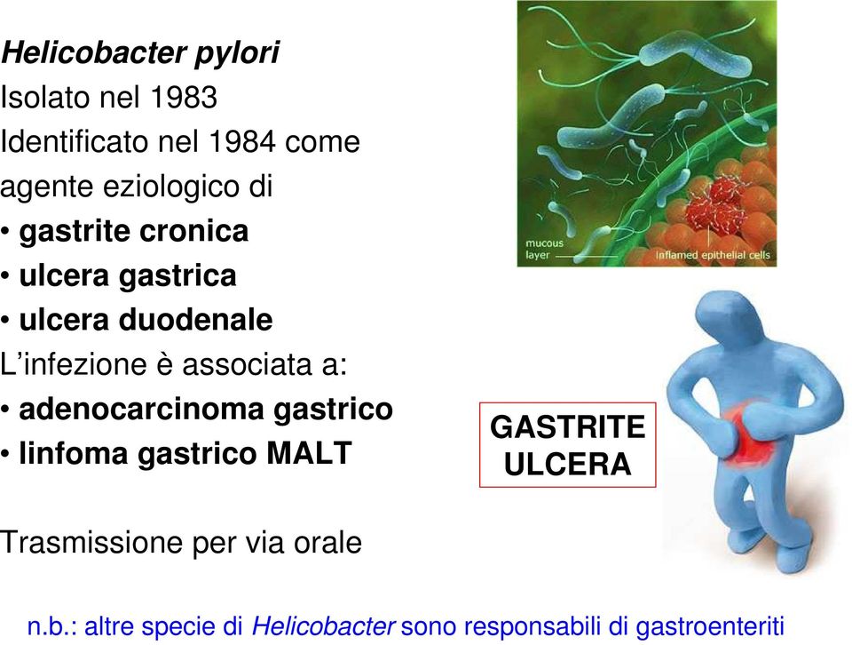 associata a: adenocarcinoma gastrico linfoma gastrico MALT GASTRITE ULCERA