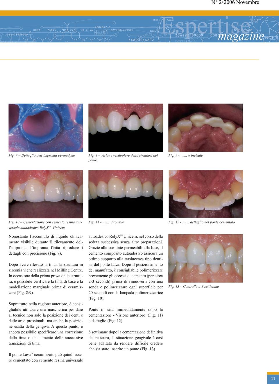 12 - dettaglio del ponte cementato Nonostante l accumulo di liquido clinicamente visibile durante il rilevamento dell impronta, l impronta finita riproduce i dettagli con precisione (Fig. 7).