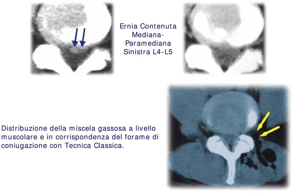 gassosa a livello muscolare e in