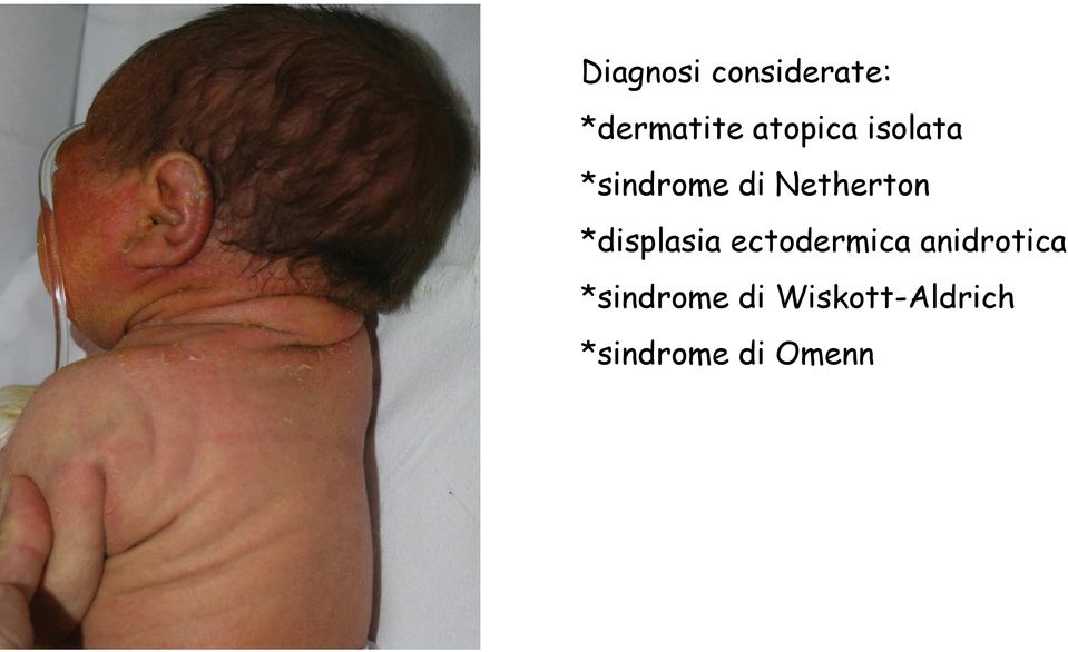 *displasia ectodermica anidrotica