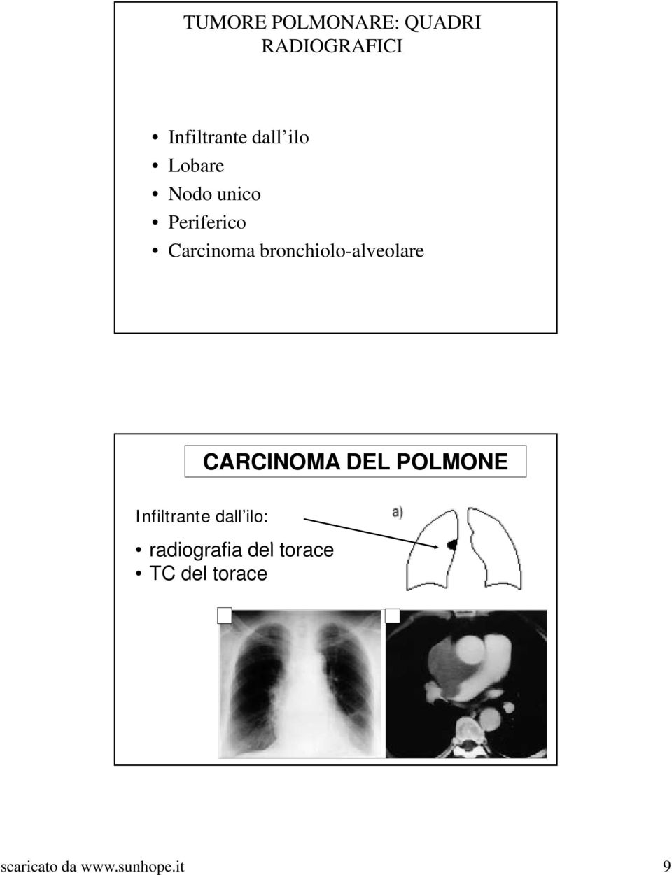 bronchiolo-alveolare CARCINOMA DEL POLMONE Infiltrante