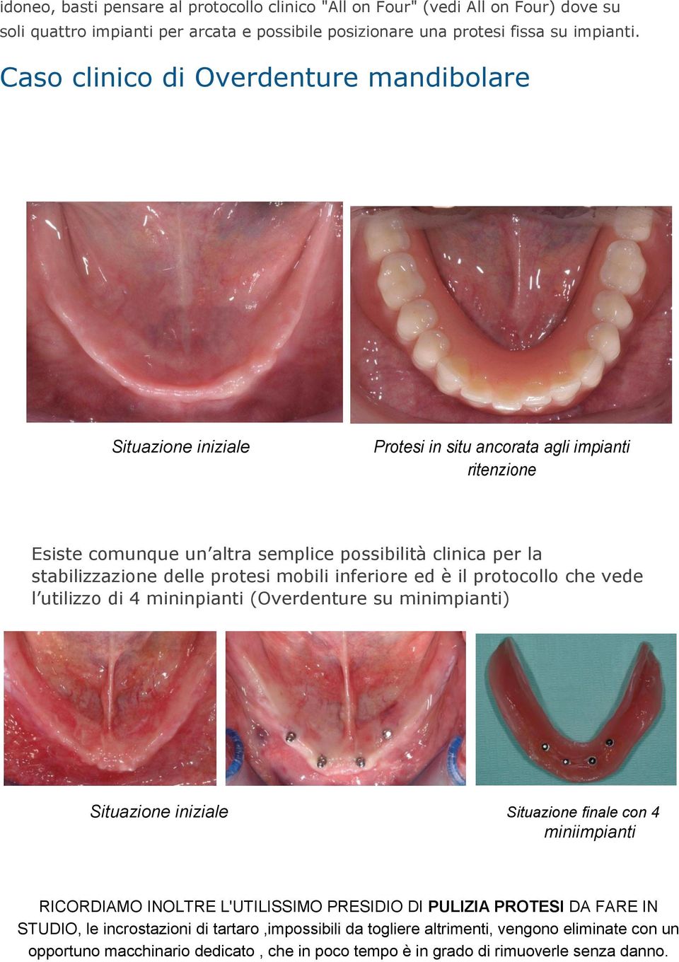 protesi mobili inferiore ed è il protocollo che vede l utilizzo di 4 mininpianti (Overdenture su minimpianti) Situazione iniziale Situazione finale con 4 miniimpianti RICORDIAMO INOLTRE