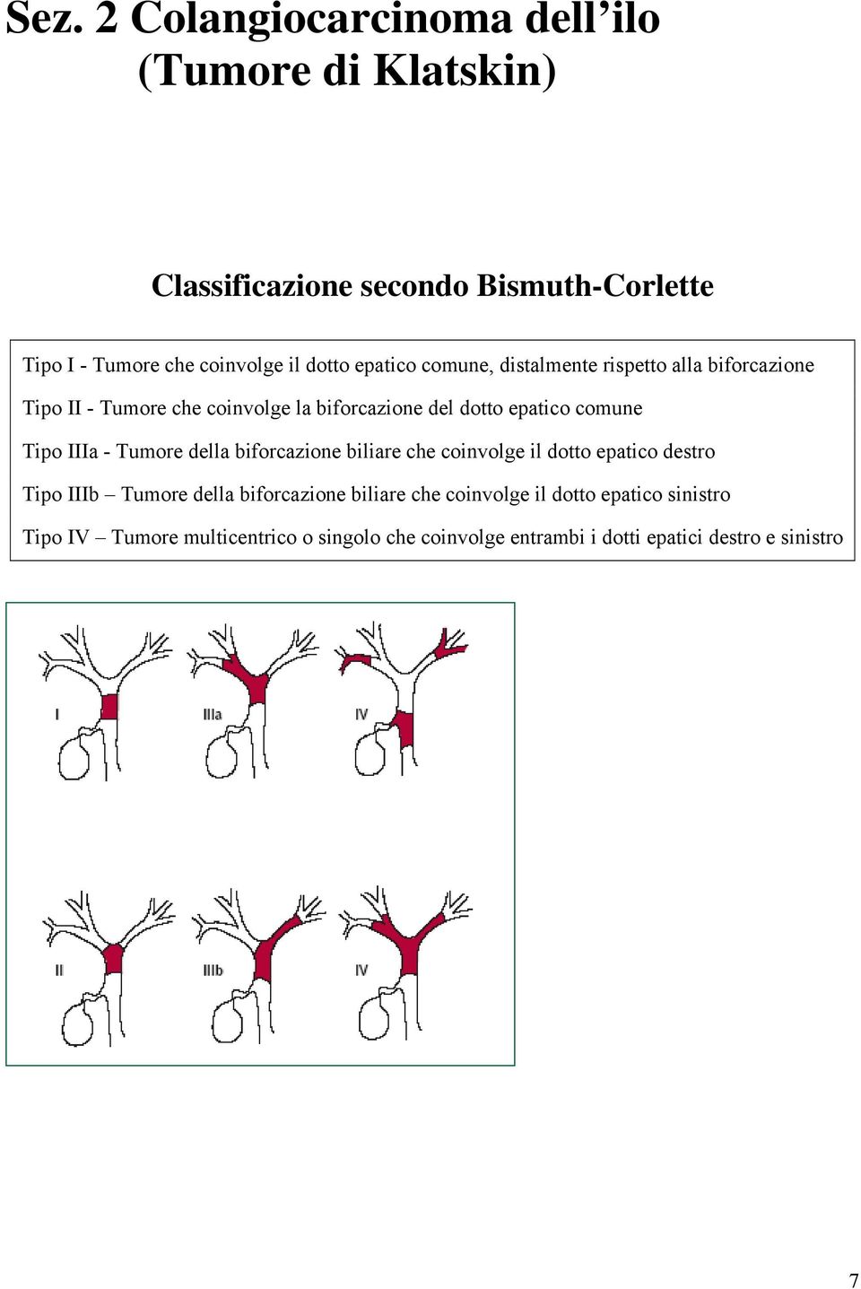 comune Tipo IIIa - Tumore della biforcazione biliare che coinvolge il dotto epatico destro Tipo IIIb Tumore della biforcazione