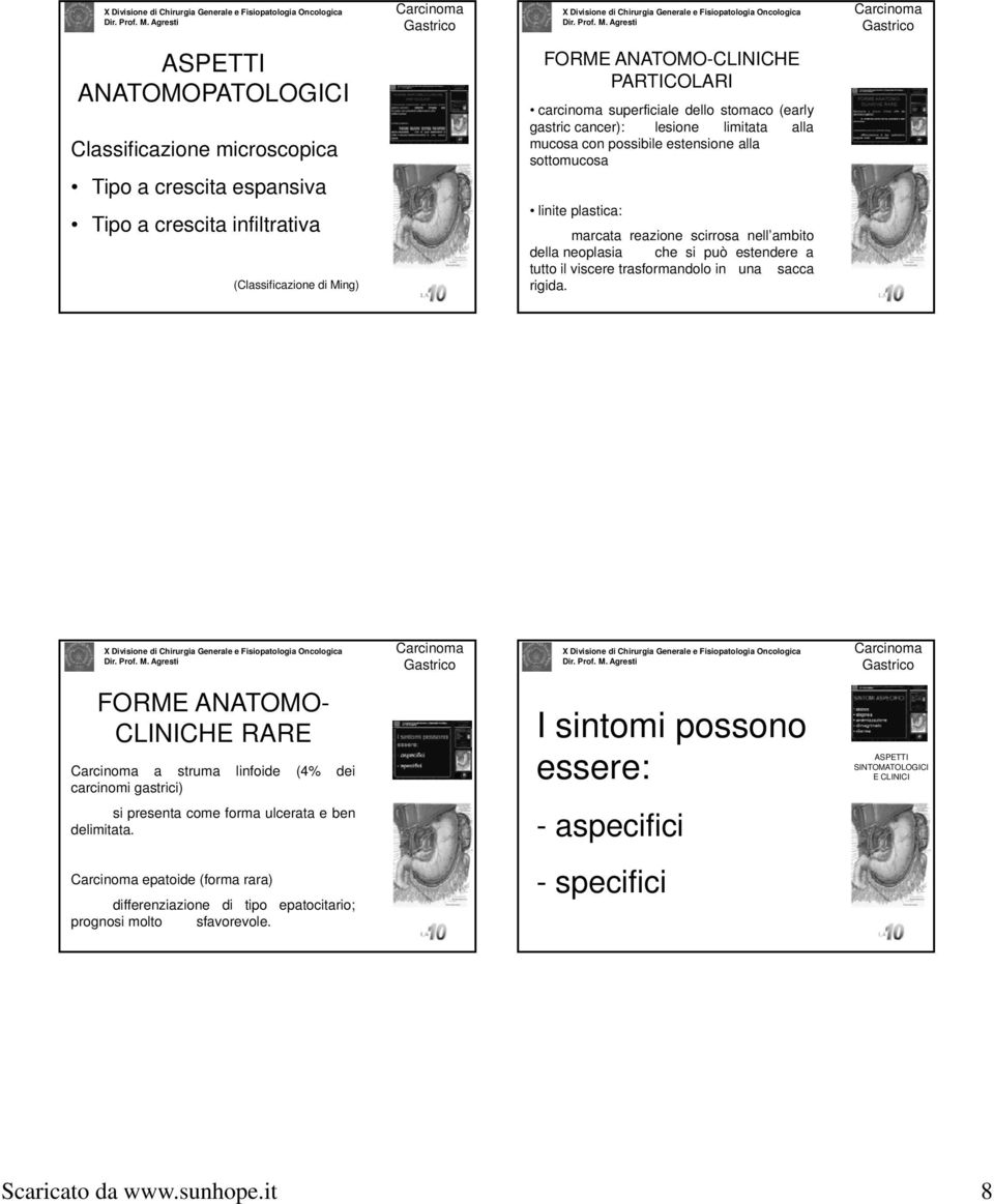 estendere a tutto il viscere trasformandolo in una sacca rigida. FORME ANATOMO- CLINICHE RARE a struma linfoide (4% dei carcinomi gastrici) si presenta come forma ulcerata e ben delimitata.