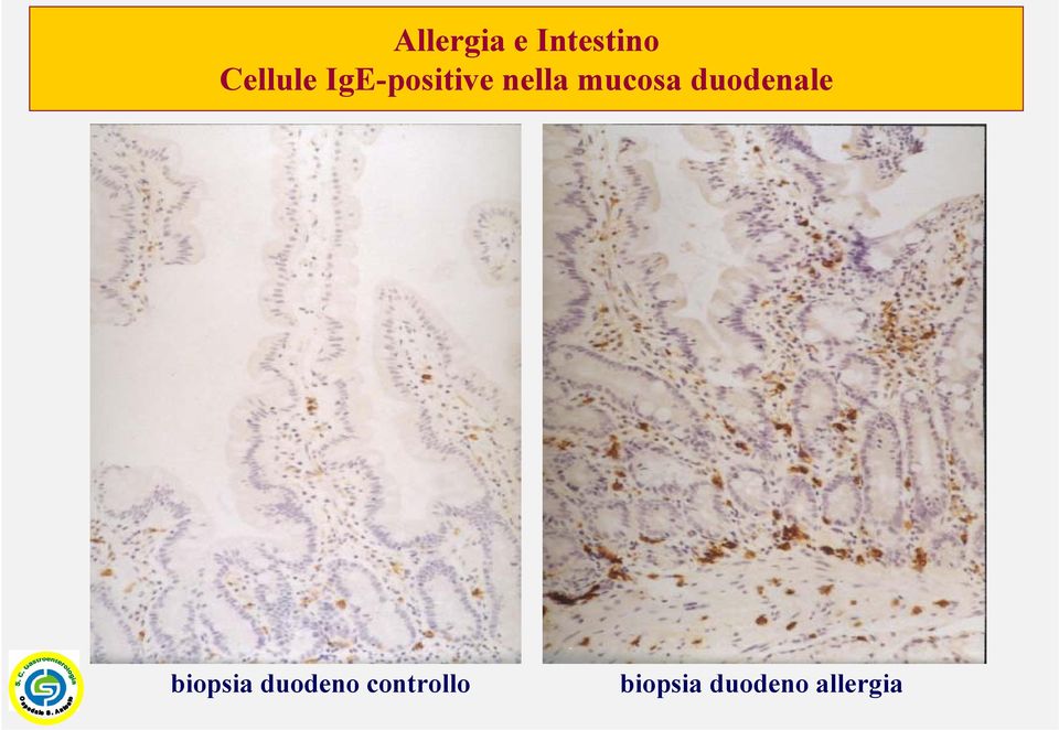 duodenale biopsia duodeno