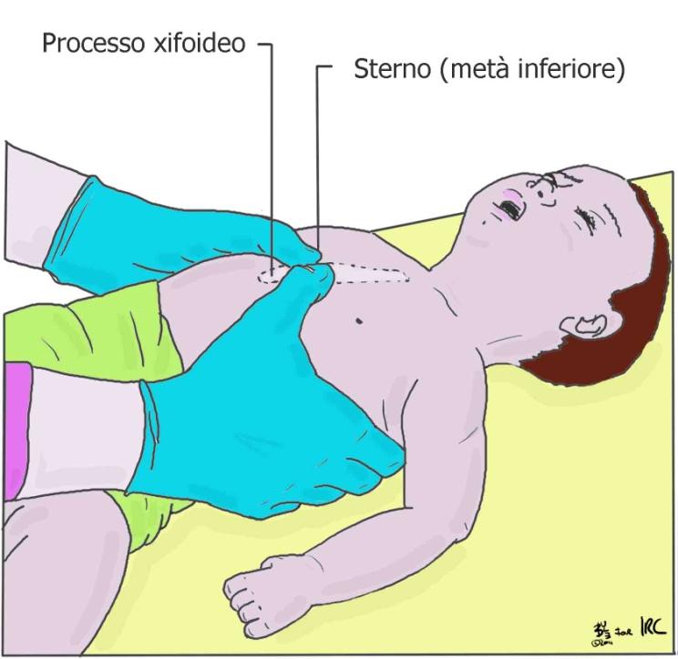 da corpo estraneo Lattante incosciente