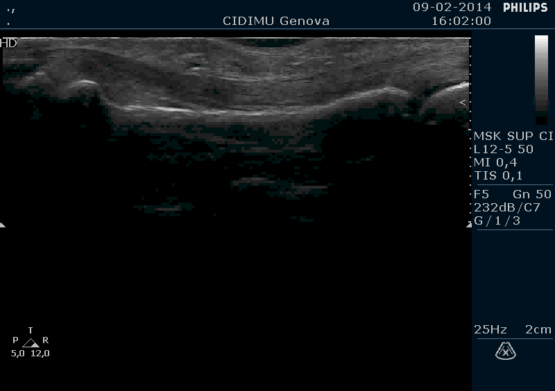 MUSCOLI E TENDINI Ganglio tendineo: Rapporto