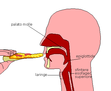 La disfagia neurogena per i solidi Il paziente è in grado di alimentarsi per os con dieta semisolida e liquida.